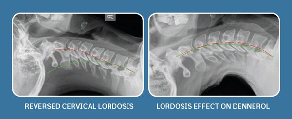 cervical lordosis