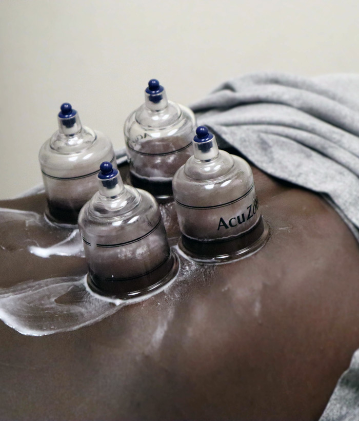 Cupping Therapy | Westlake Village Chiropractor